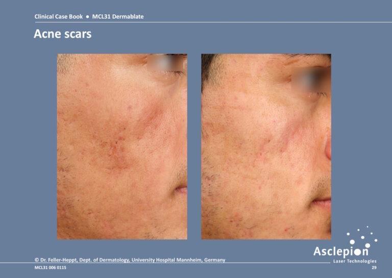 Before and after acne scar resurfacing on a male patient with the Dermablate Er:YAG laser, Dept. of Dermatology, University Hospital Mannheim