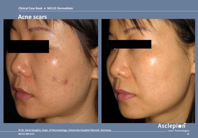 Before and after acne scar treatment on a female patient with the Dermablate Er:YAG laser, Dept. of Dermatology, University Hospital Munich