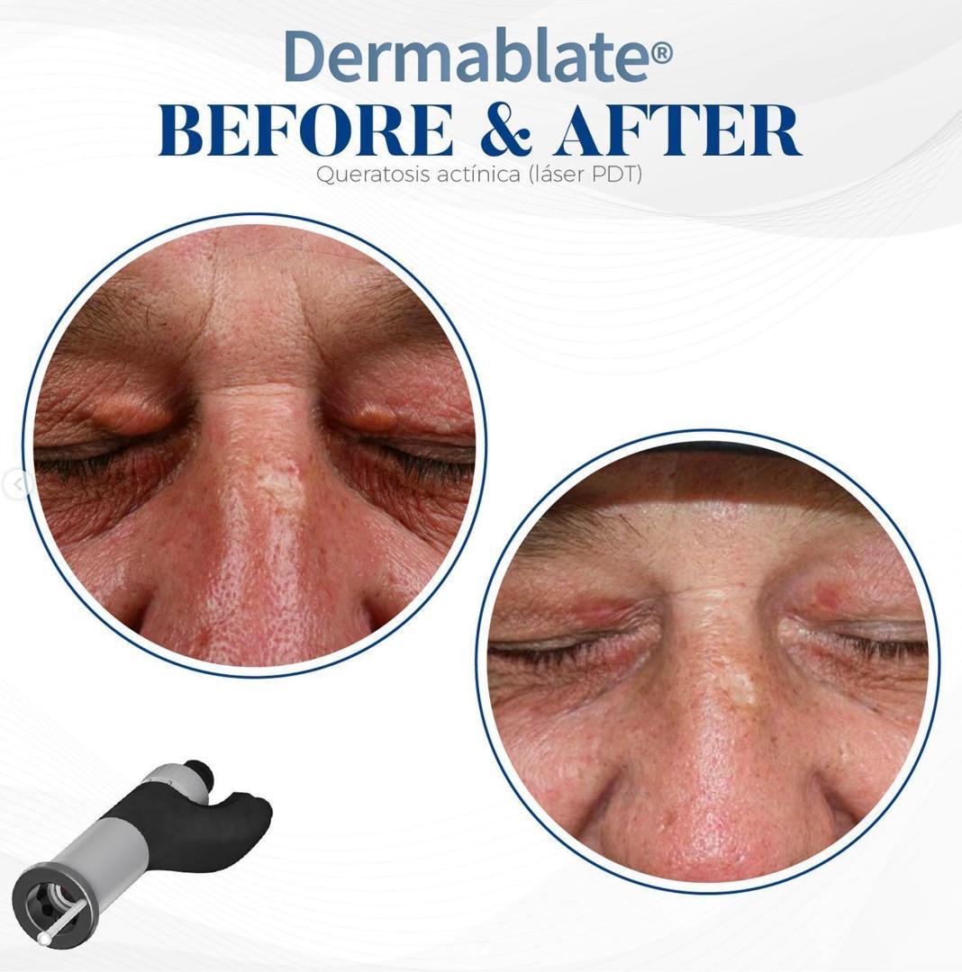 Before and after periorbital actinic keratosis cleared with Dermablate laser PDT