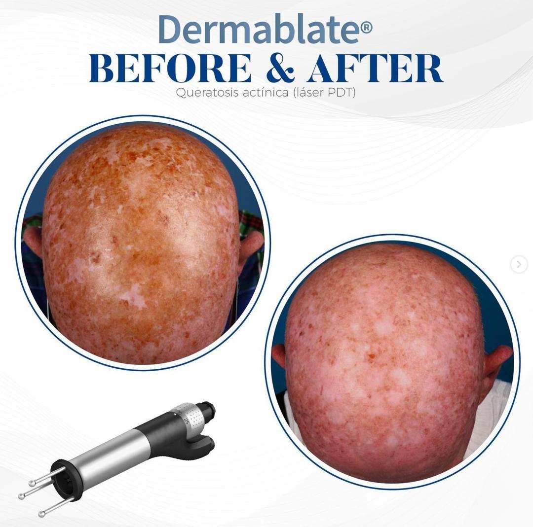 Before and after actinic keratoses on the scalp treated with Dermablate laser PDT