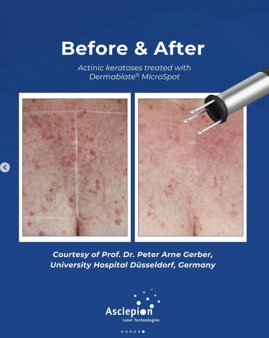 Before and after actinic keratoses on the chest treated with the Dermablate MicroSpot handpiece