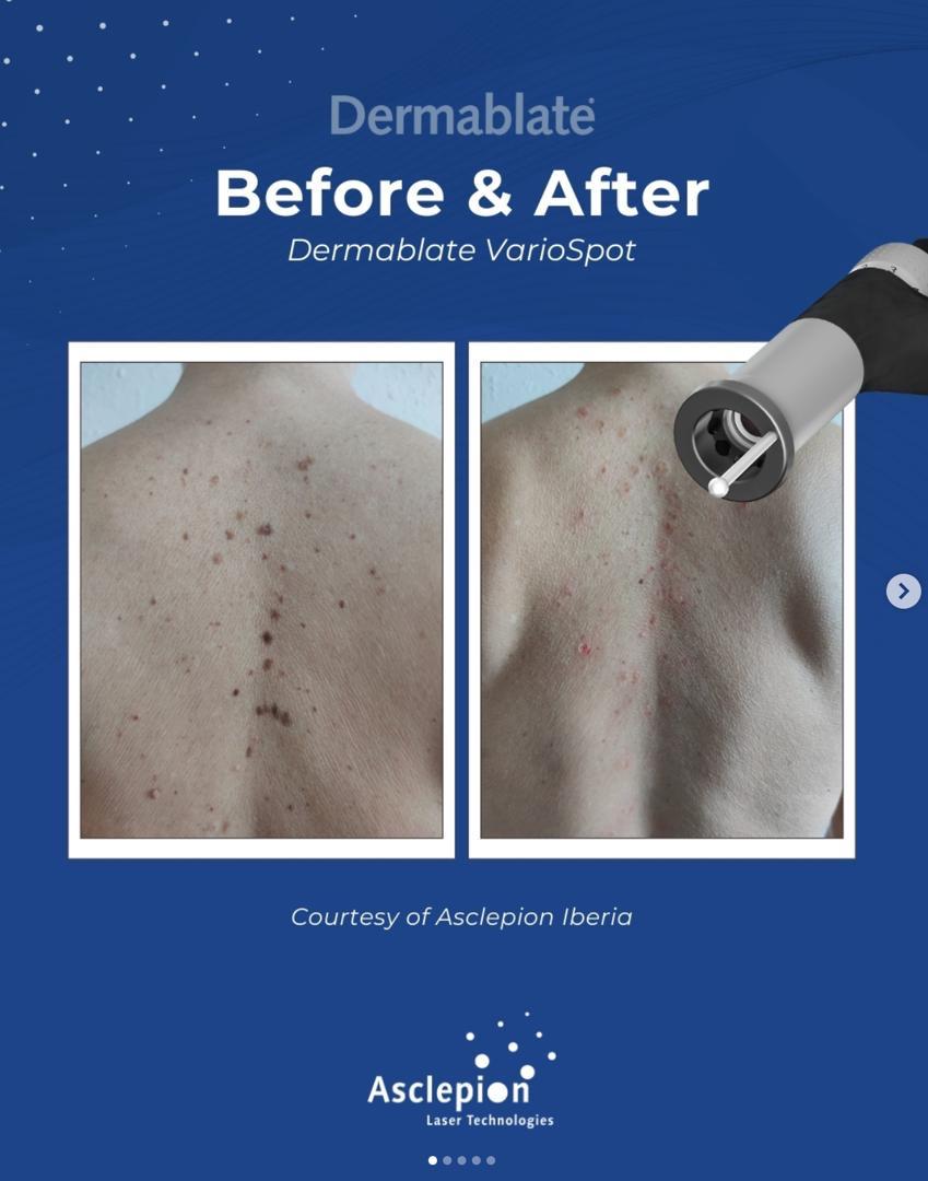 Before and after removal of pigmented spots and moles on the back using the Dermablate VarioSpot handpiece