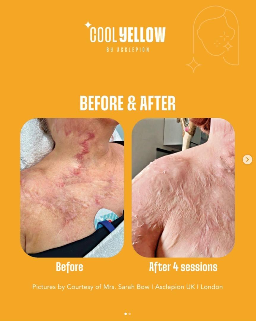Before and after hypertrophic scar treatment on the chest and shoulder after four Cool Yellow by Asclepion sessions