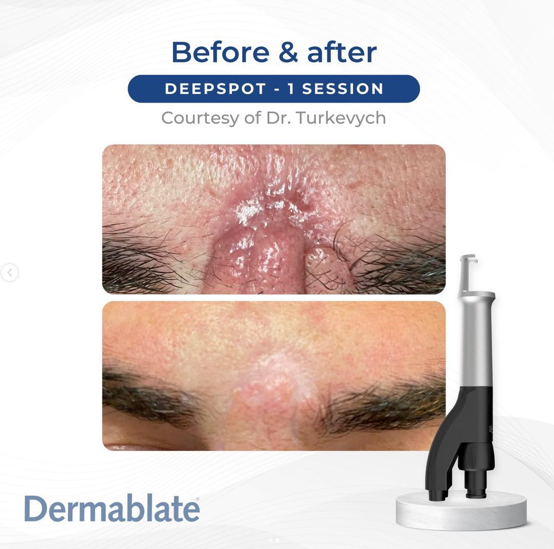 Before and after a raised glabella lesion cleared in a single Dermablate DeepSpot session