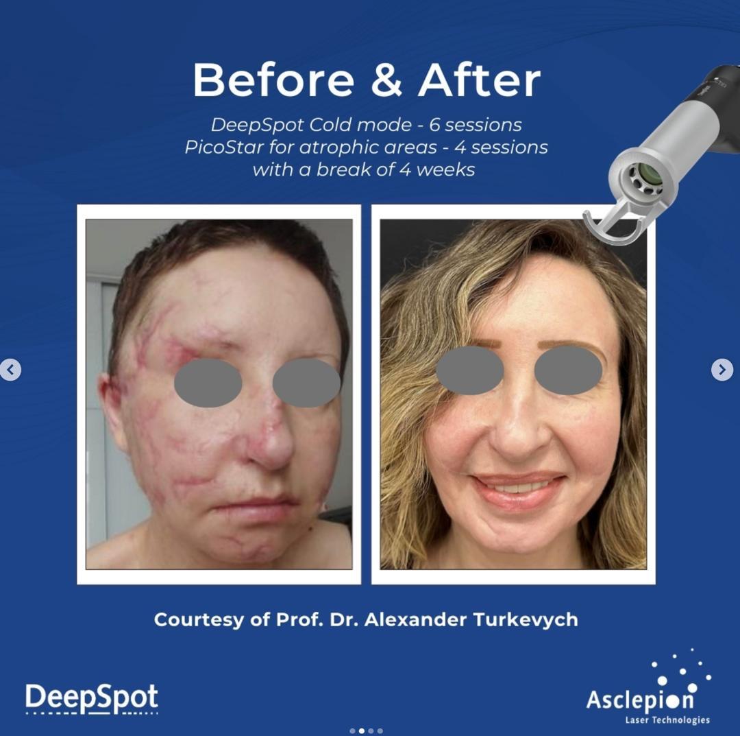 Before and after facial scar revision using Dermablate DeepSpot cold mode over six sessions combined with PicoStar for atrophic areas