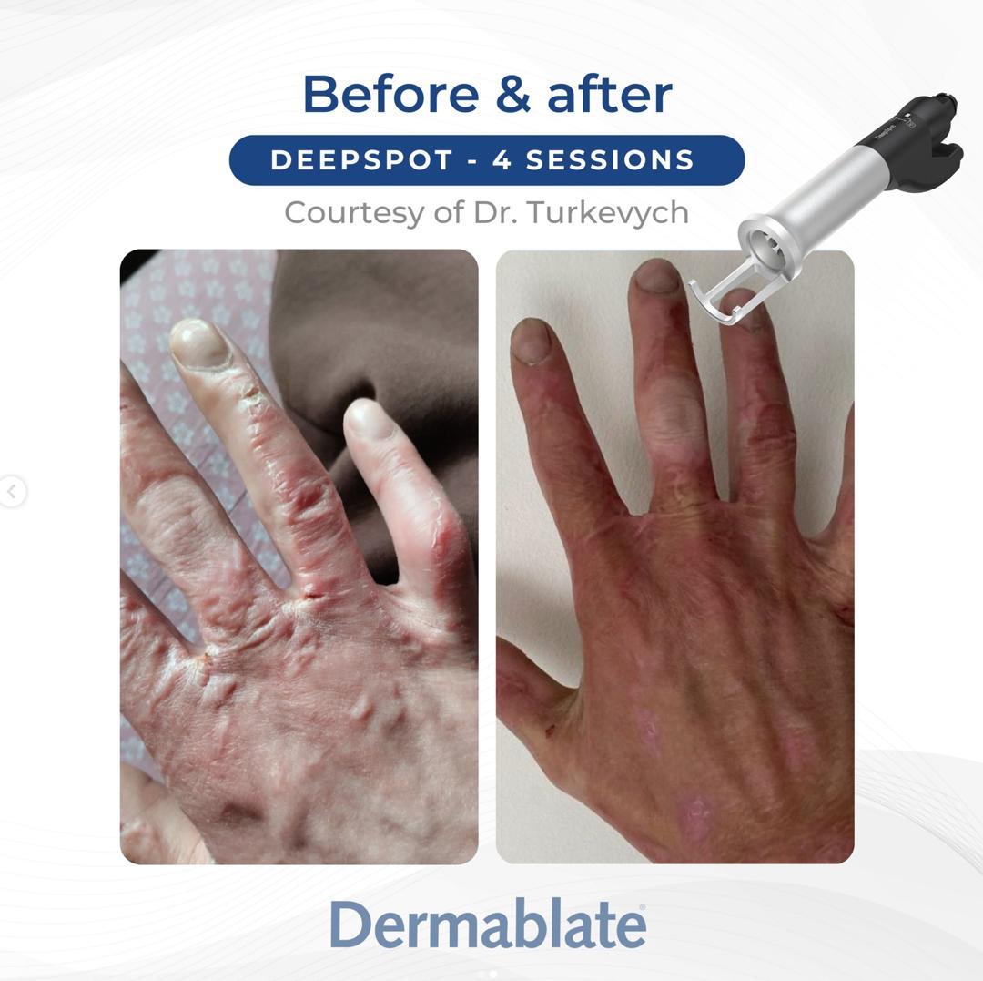 Before and after scar revision on the hand after four Dermablate DeepSpot sessions
