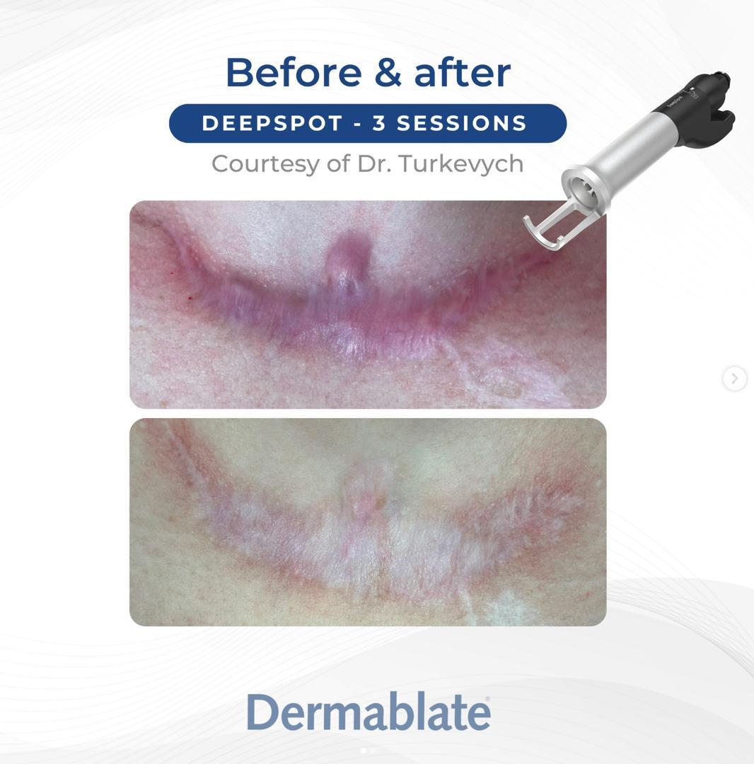 Before and after a raised hypertrophic surgical scar flattened after three Dermablate DeepSpot sessions
