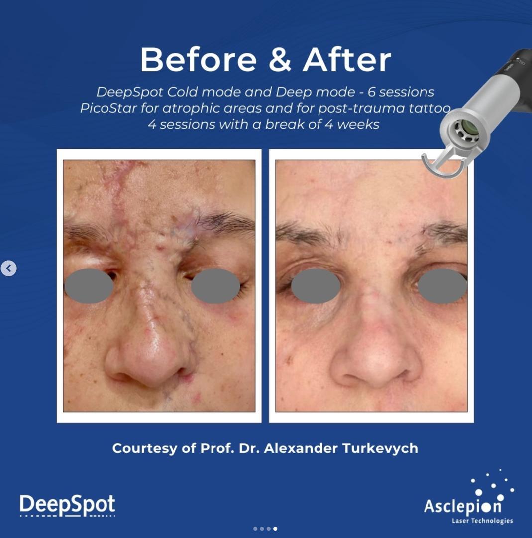 Before and after facial trauma scarring and post-trauma tattoo treated over six Dermablate DeepSpot cold and deep mode sessions with PicoStar