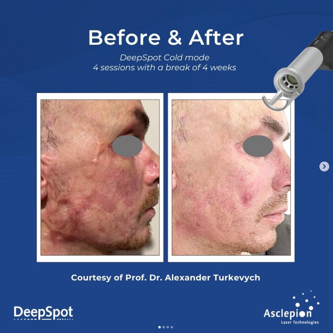 Before and after extensive facial burn scarring on a male patient after four Dermablate DeepSpot cold mode sessions