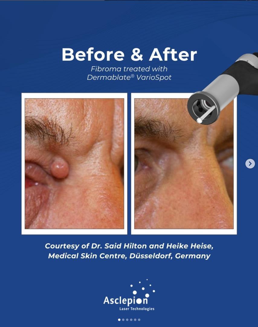 Before and after fibroma removal beside the eye using the Dermablate VarioSpot handpiece, Medical Skin Centre Düsseldorf