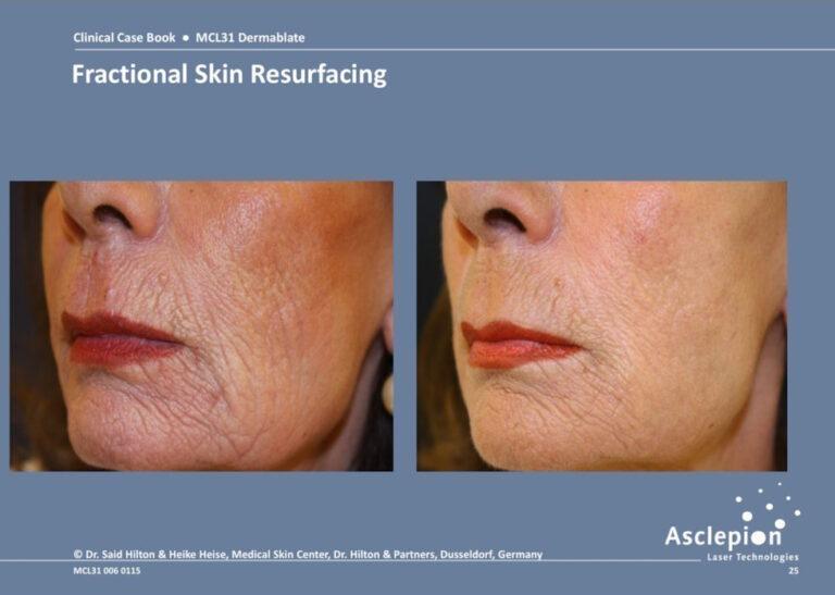 Before and after fractional skin resurfacing of perioral wrinkles with the Dermablate Er:YAG laser, Medical Skin Center Düsseldorf