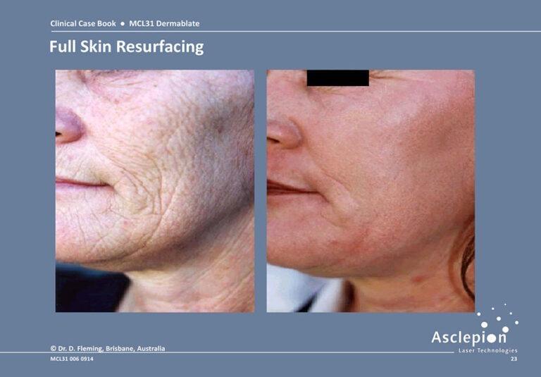 Before and after full-field Dermablate Er:YAG resurfacing of cheek and jawline wrinkles on a female patient, Brisbane, Australia