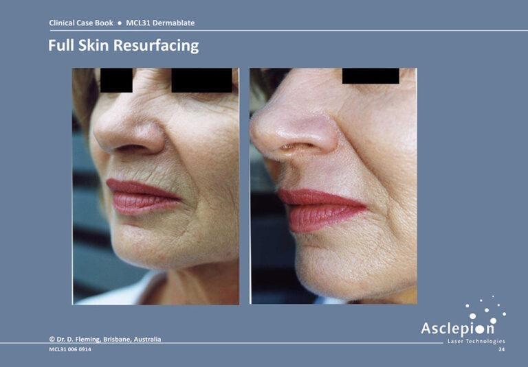 Before and after full-field Er:YAG skin resurfacing of perioral and nasolabial wrinkles with the Dermablate laser, Brisbane, Australia