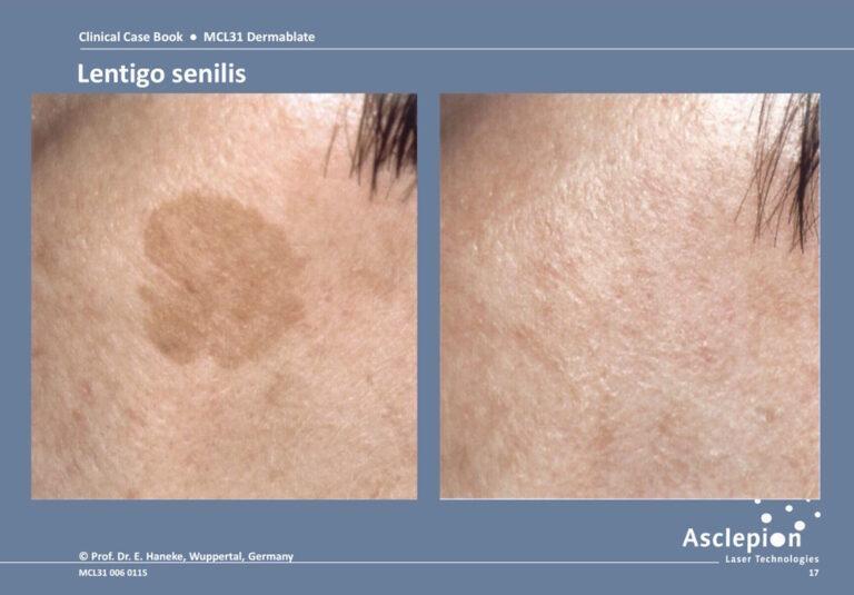 Before and after complete clearance of a lentigo senilis age spot on the forehead with the Dermablate Er:YAG laser, Prof. Dr. E. Haneke, Wuppertal