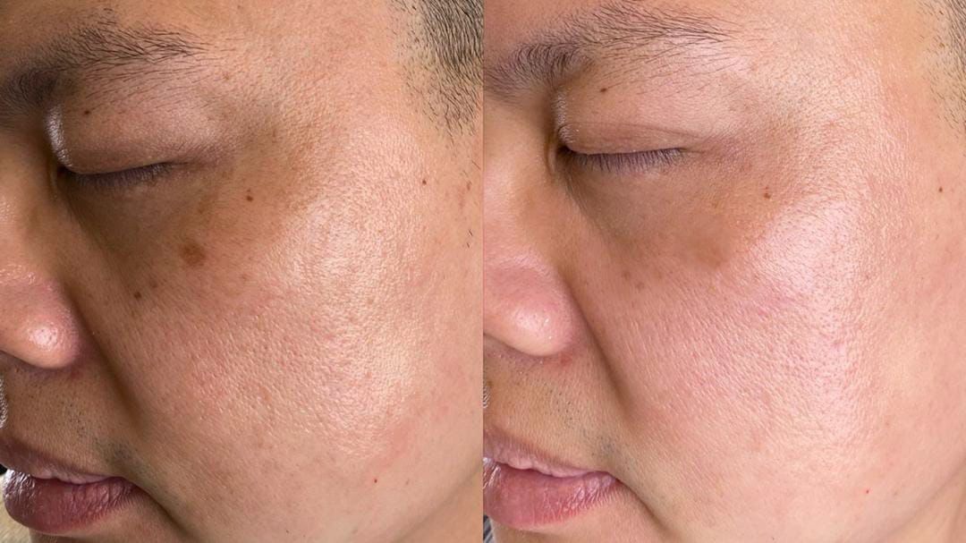Before and after pigmentation clearance on the cheek of an Asian male patient with laser treatment