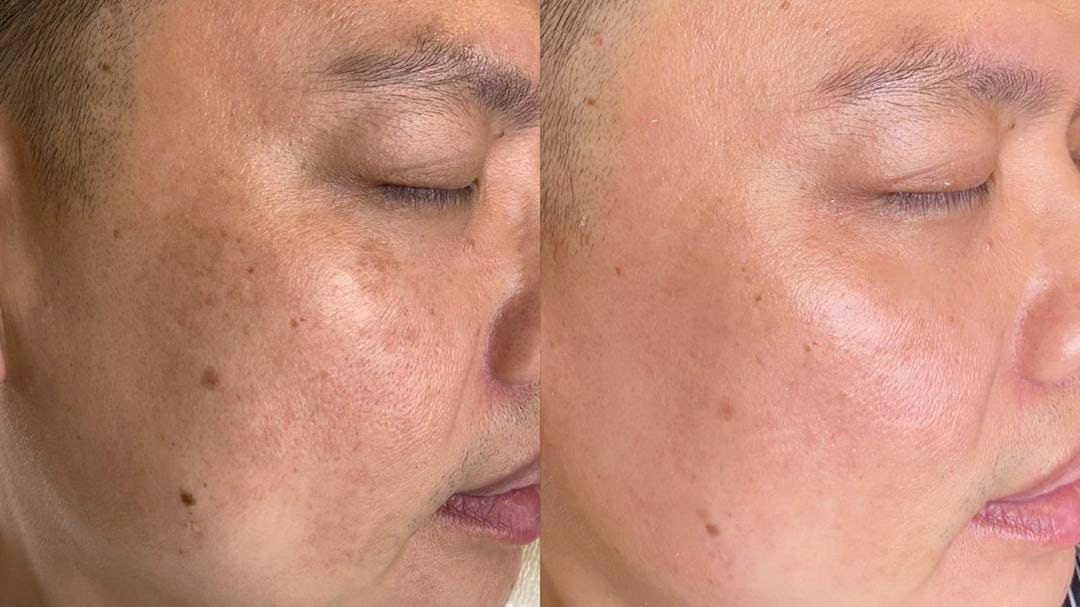 Before and after heavy facial pigmentation cleared on an Asian male patient with laser treatment