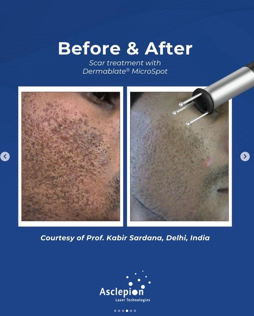 Before and after acne scar treatment on darker skin using the Dermablate MicroSpot handpiece, Delhi, India
