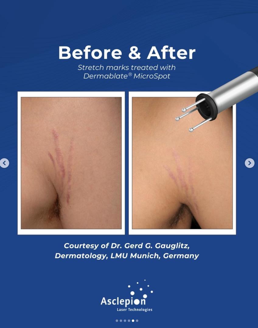 Before and after stretch mark treatment with the Dermablate MicroSpot handpiece, Dermatology, LMU Munich