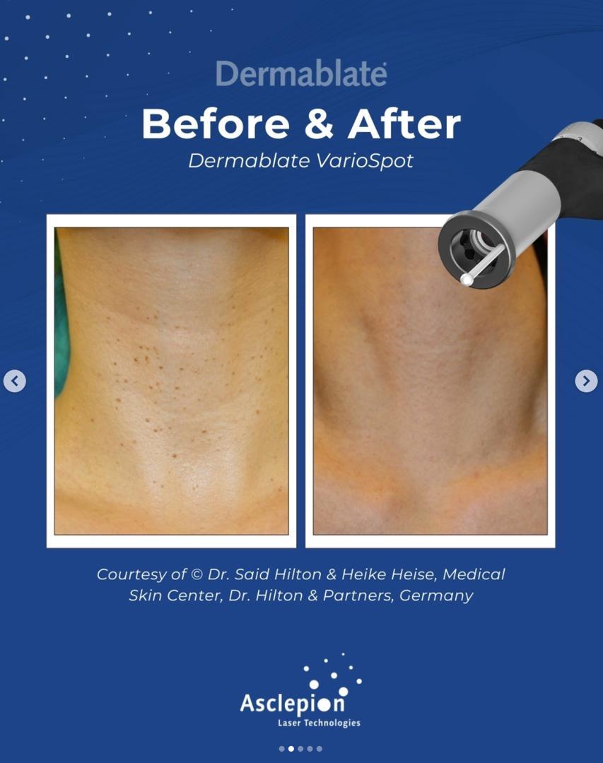 Before and after removal of multiple raised moles and spots on the neck and décolleté with the Dermablate VarioSpot handpiece, Medical Skin Center Düsseldorf