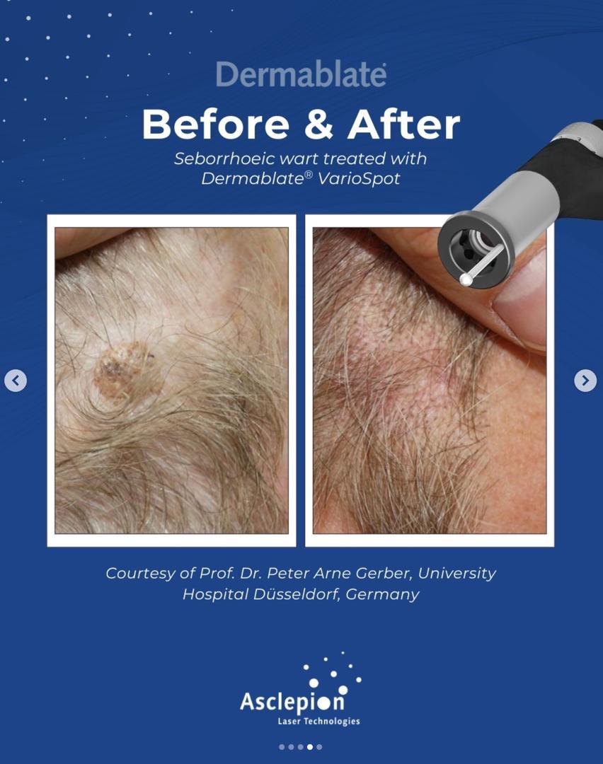 Before and after seborrhoeic wart removal on the scalp using the Dermablate VarioSpot handpiece, University Hospital Düsseldorf