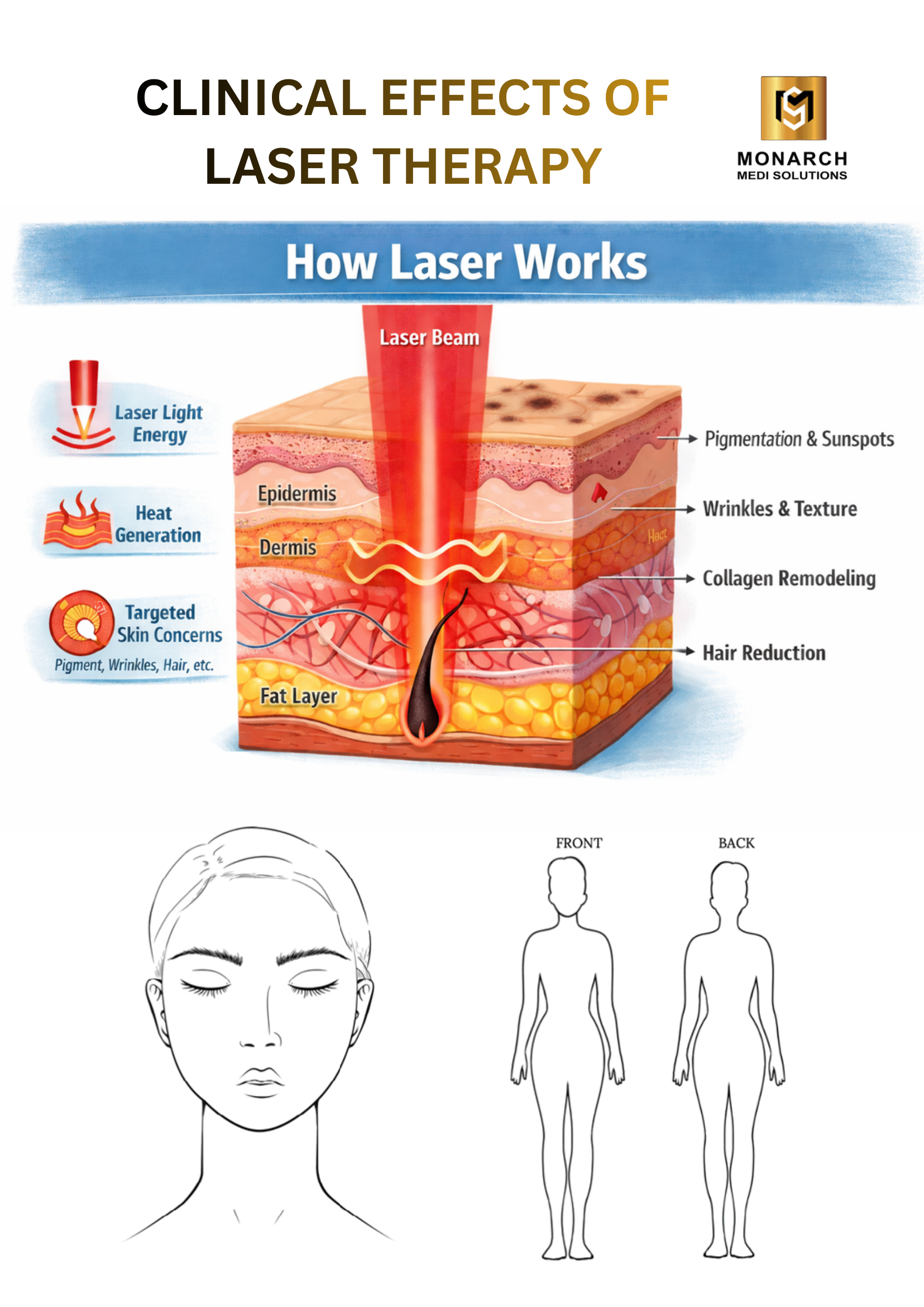 How laser works diagram showing laser light energy and heat generation reaching the dermis, where CO2 fractional columns drive collagen remodelling